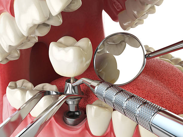 Best Emergency Root Canal Treatment in Lyndhurst, VA